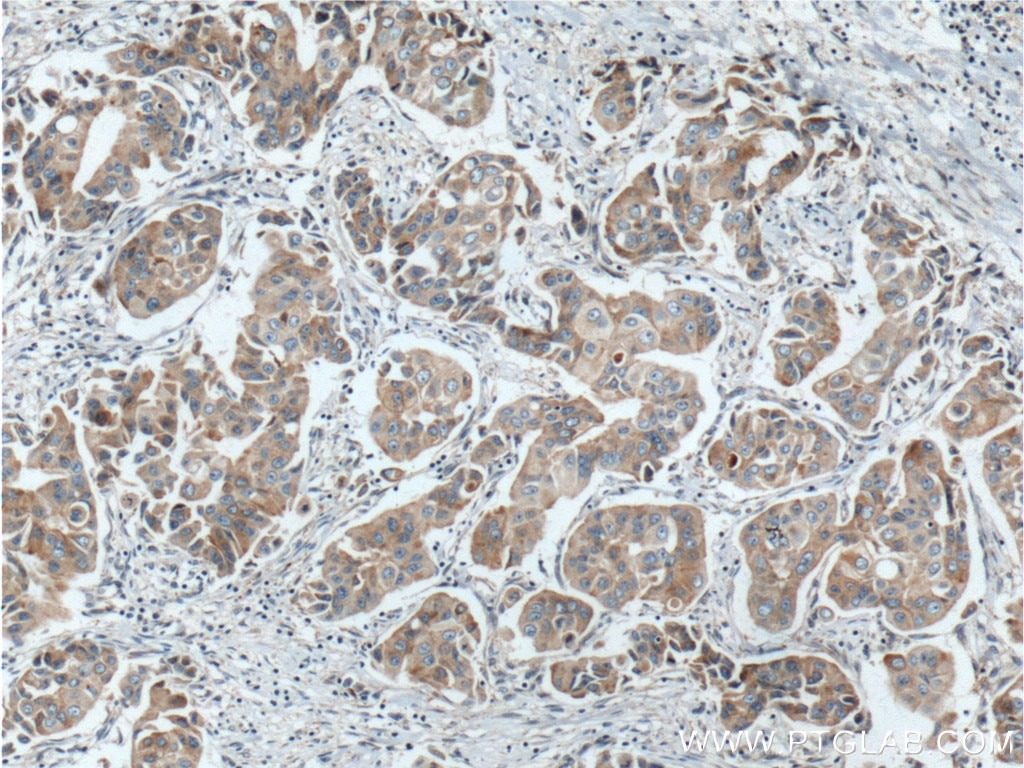 Immunohistochemistry (IHC) staining of human breast cancer tissue using PLDN Polyclonal antibody (10891-2-AP)