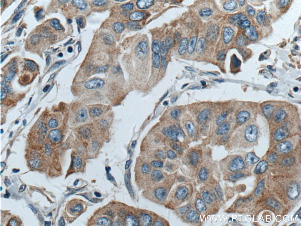 Immunohistochemistry (IHC) staining of human breast cancer tissue using PLDN Polyclonal antibody (10891-2-AP)