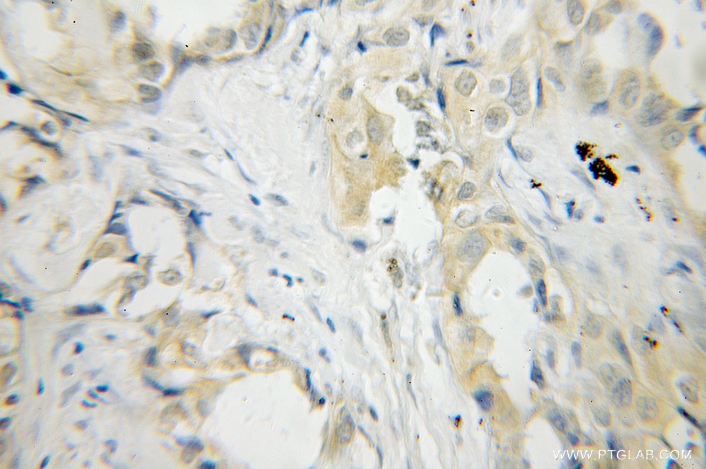 Immunohistochemistry (IHC) staining of human lung cancer tissue using PLEK Polyclonal antibody (12506-1-AP)
