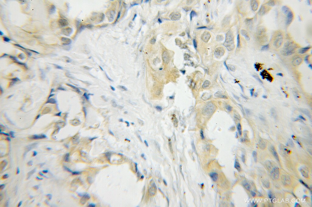 Immunohistochemistry (IHC) staining of human lung cancer tissue using PLEK Polyclonal antibody (12506-1-AP)