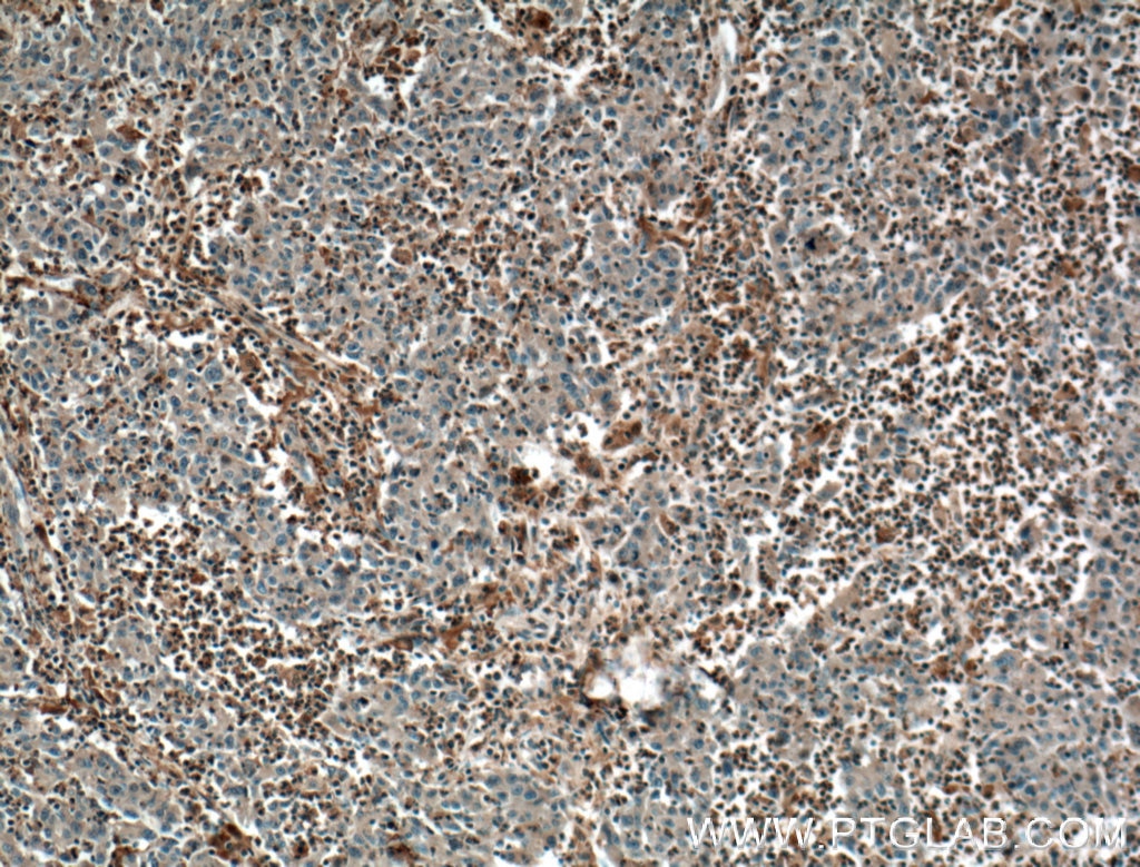 Immunohistochemistry (IHC) staining of human colon cancer tissue using PLEK Monoclonal antibody (66431-1-Ig)