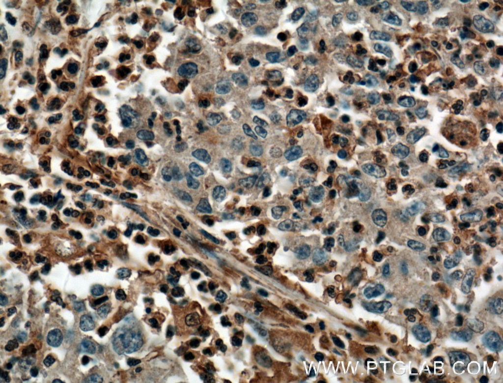 Immunohistochemistry (IHC) staining of human colon cancer tissue using PLEK Monoclonal antibody (66431-1-Ig)