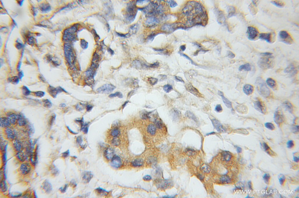 Immunohistochemistry (IHC) staining of human pancreas cancer tissue using PLEK2 Polyclonal antibody (11685-1-AP)