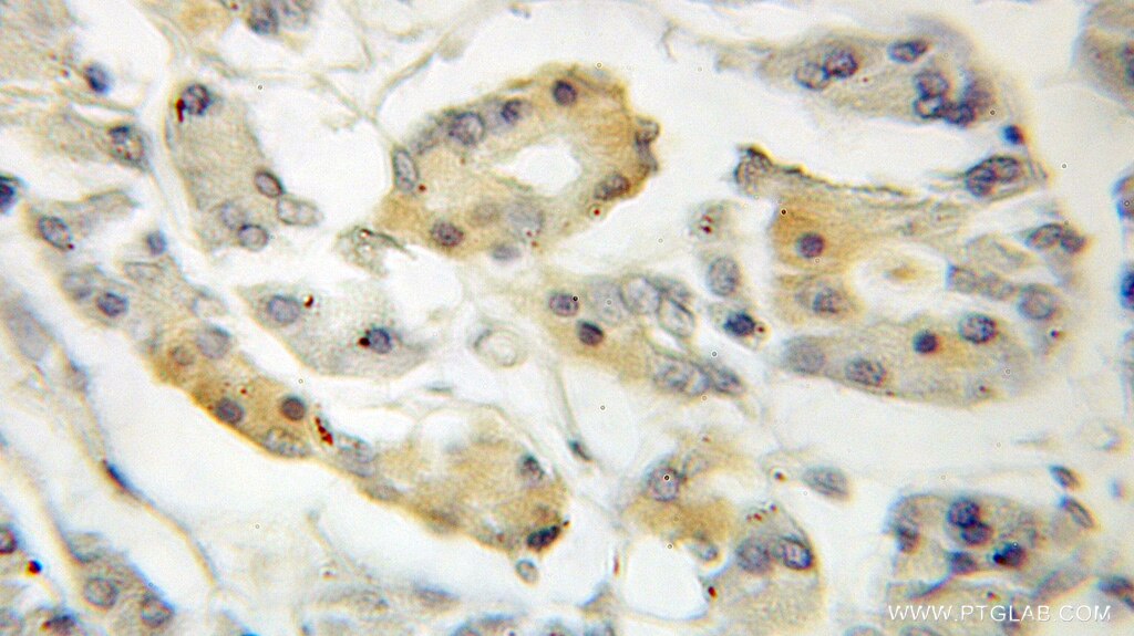 Immunohistochemistry (IHC) staining of human pancreas cancer tissue using PLEKHA1 Polyclonal antibody (10238-1-AP)