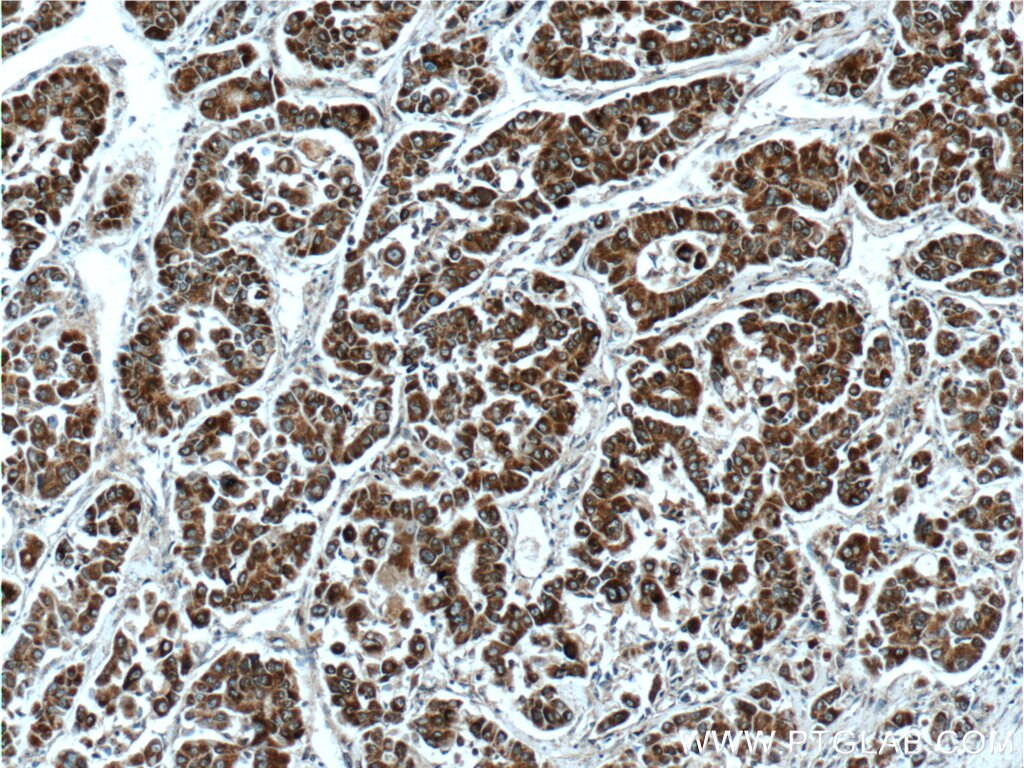 Immunohistochemistry (IHC) staining of human liver cancer tissue using PLEKHB2 Polyclonal antibody (16265-1-AP)