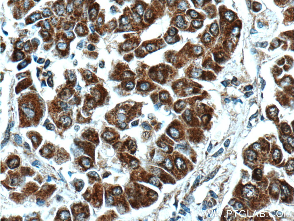 Immunohistochemistry (IHC) staining of human liver cancer tissue using PLEKHB2 Polyclonal antibody (16265-1-AP)