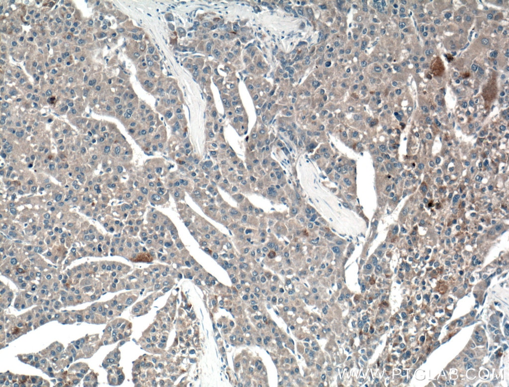 Immunohistochemistry (IHC) staining of human liver cancer tissue using PLEKHM1 Polyclonal antibody (16202-1-AP)