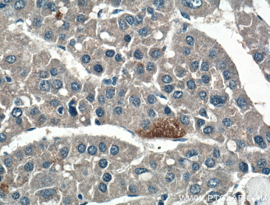 Immunohistochemistry (IHC) staining of human liver cancer tissue using PLEKHM1 Polyclonal antibody (16202-1-AP)