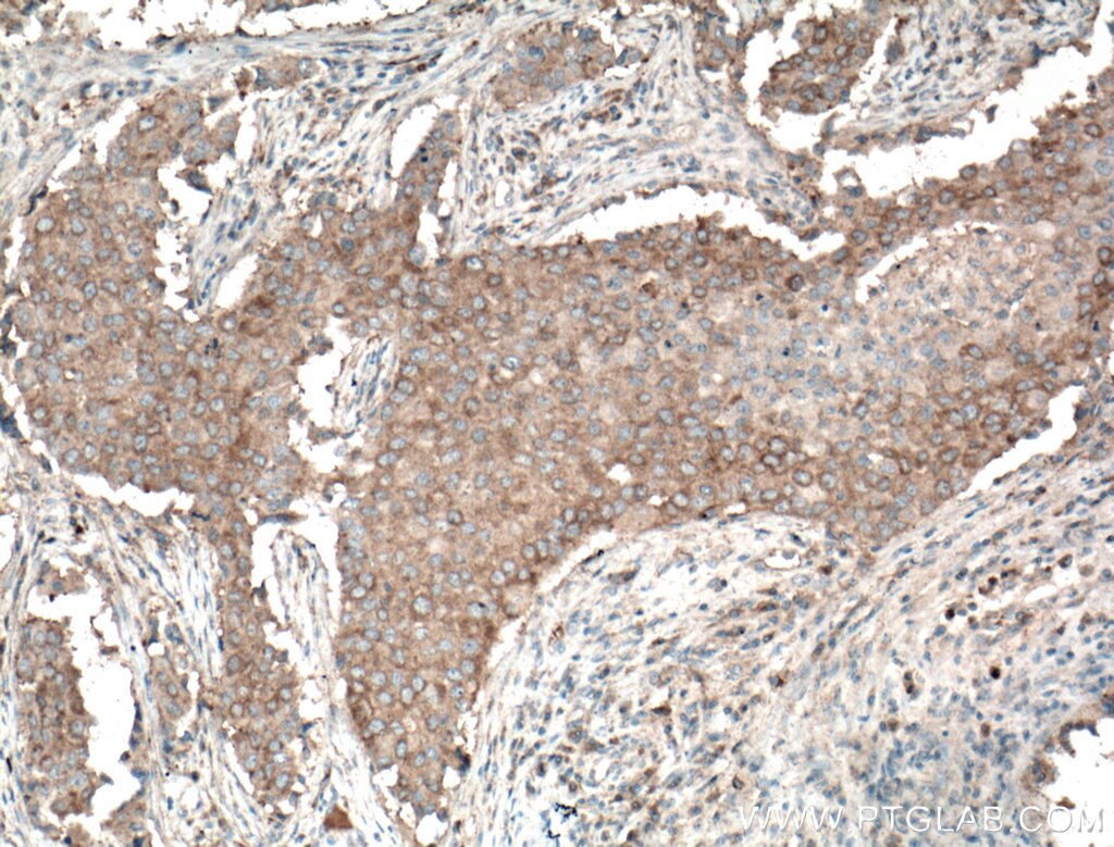 Immunohistochemistry (IHC) staining of human breast cancer tissue using PLEKHM1 Polyclonal antibody (16202-1-AP)