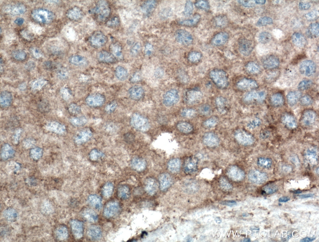 Immunohistochemistry (IHC) staining of human breast cancer tissue using PLEKHM1 Polyclonal antibody (16202-1-AP)