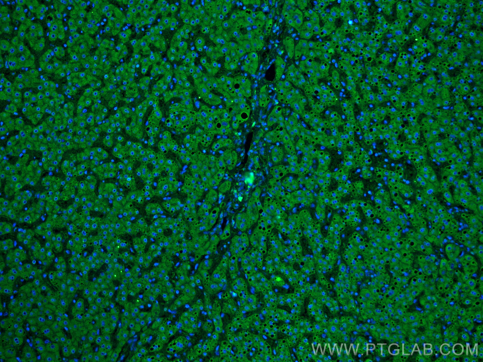 Immunofluorescence (IF) / fluorescent staining of human liver cancer tissue using Plasminogen Monoclonal antibody (66399-1-Ig)