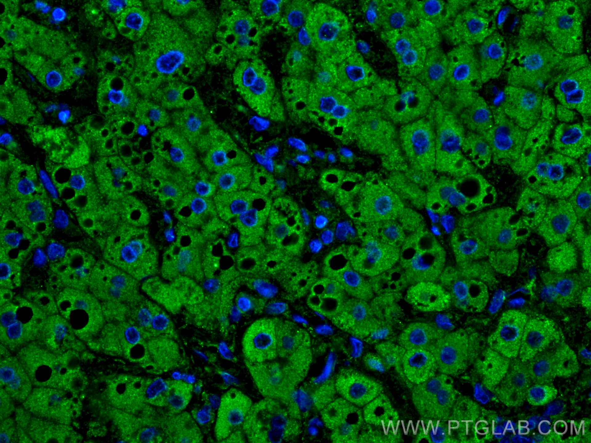 Immunofluorescence (IF) / fluorescent staining of human liver cancer tissue using Plasminogen Monoclonal antibody (66399-1-Ig)