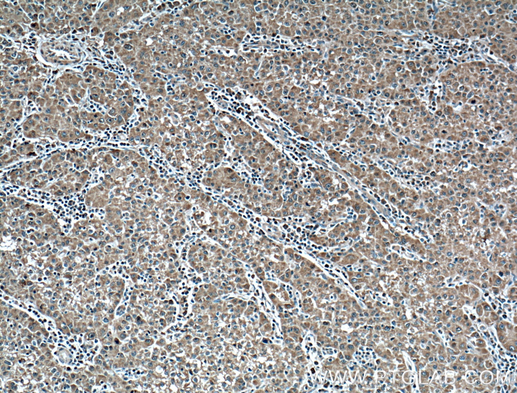 Immunohistochemistry (IHC) staining of human liver cancer tissue using Plasminogen Monoclonal antibody (66399-1-Ig)