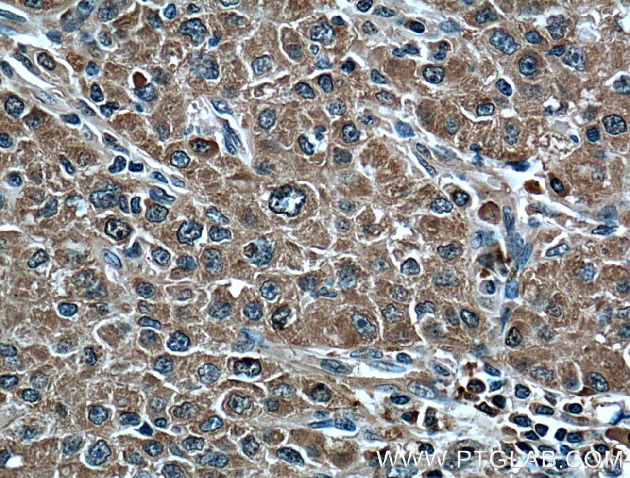 Immunohistochemistry (IHC) staining of human liver cancer tissue using Plasminogen Monoclonal antibody (66399-1-Ig)