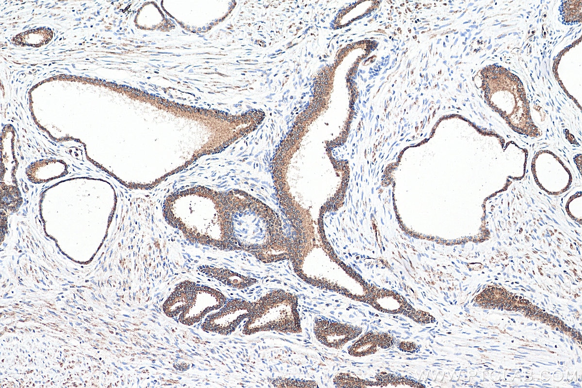 Immunohistochemistry (IHC) staining of human prostate cancer tissue using PLK1 Polyclonal antibody (10305-1-AP)
