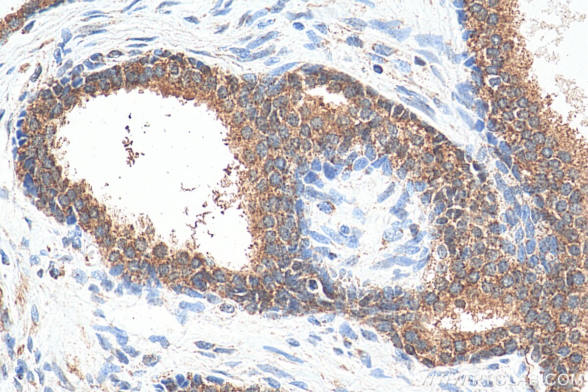 Immunohistochemistry (IHC) staining of human prostate cancer tissue using PLK1 Polyclonal antibody (10305-1-AP)