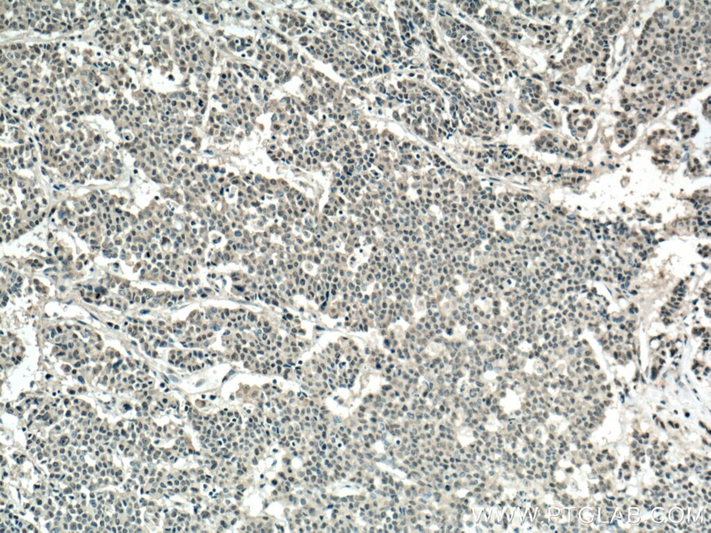 Immunohistochemistry (IHC) staining of human colon cancer tissue using PLK1 Polyclonal antibody (12098-1-AP)