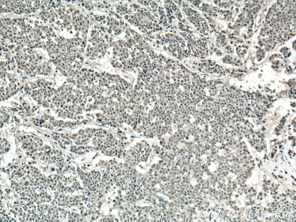 IHC staining of human colon cancer using 12098-1-AP