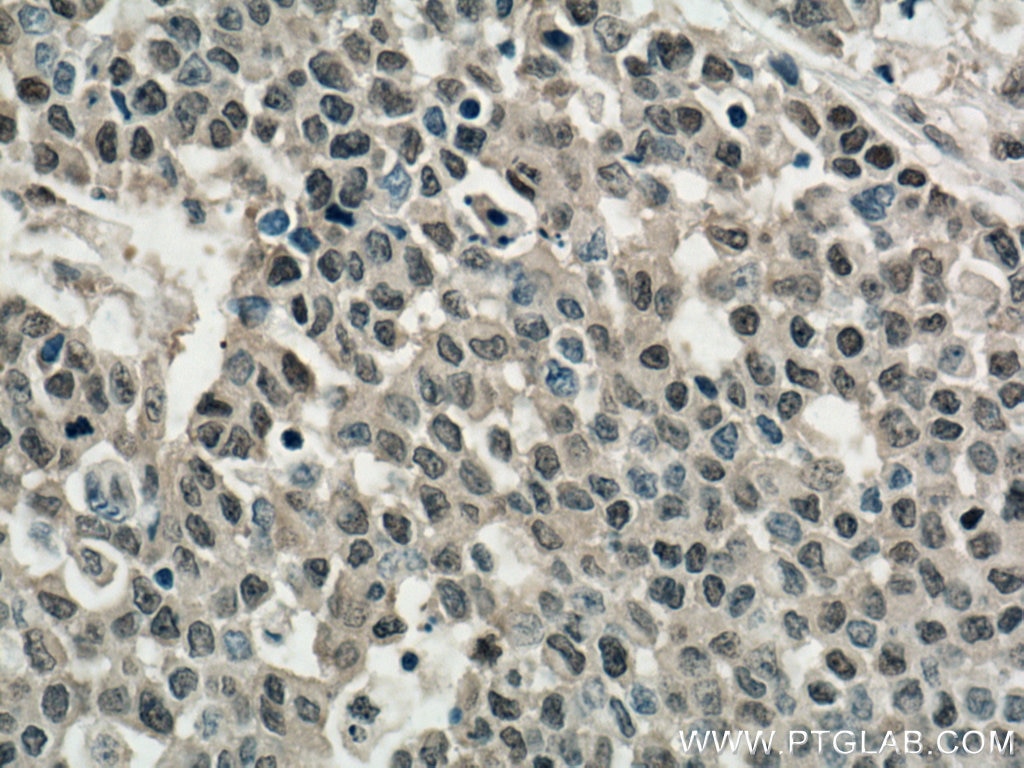 Immunohistochemistry (IHC) staining of human colon cancer tissue using PLK1 Polyclonal antibody (12098-1-AP)