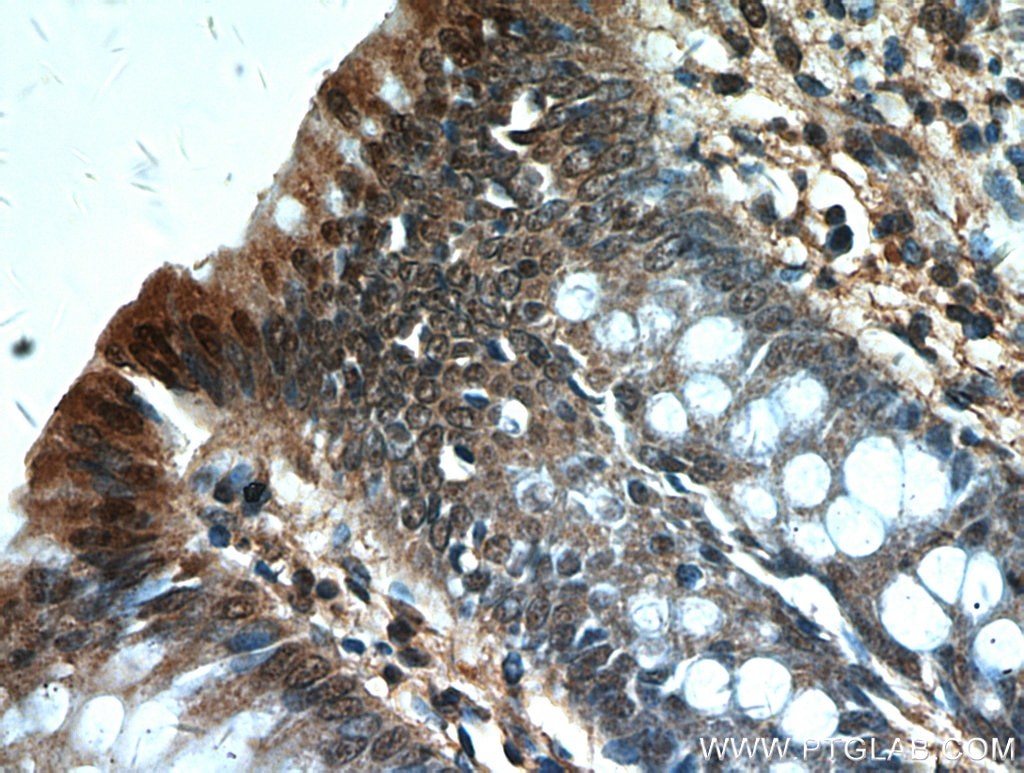 Immunohistochemistry (IHC) staining of human colon tissue using Phospho-PLK1 (Ser326) Polyclonal antibody (19553-1-AP)