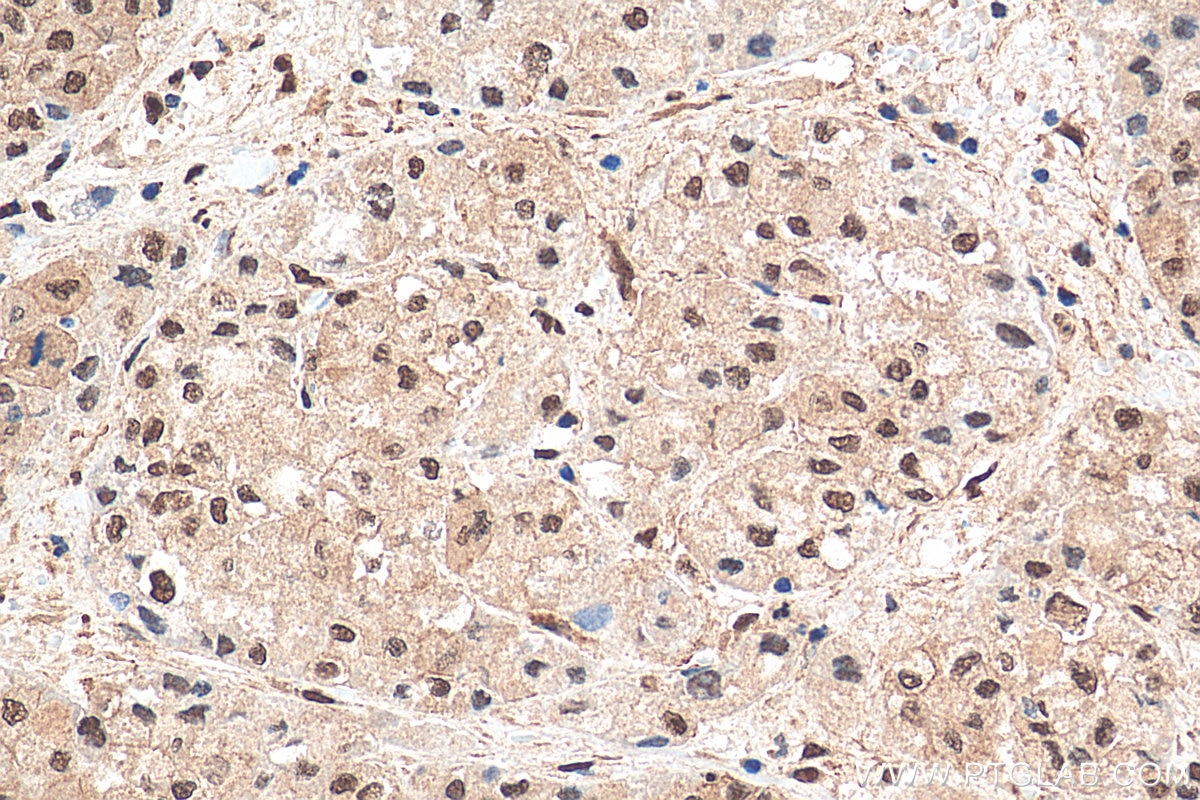 Immunohistochemistry (IHC) staining of human liver cancer tissue using PLK3 Polyclonal antibody (10977-1-AP)