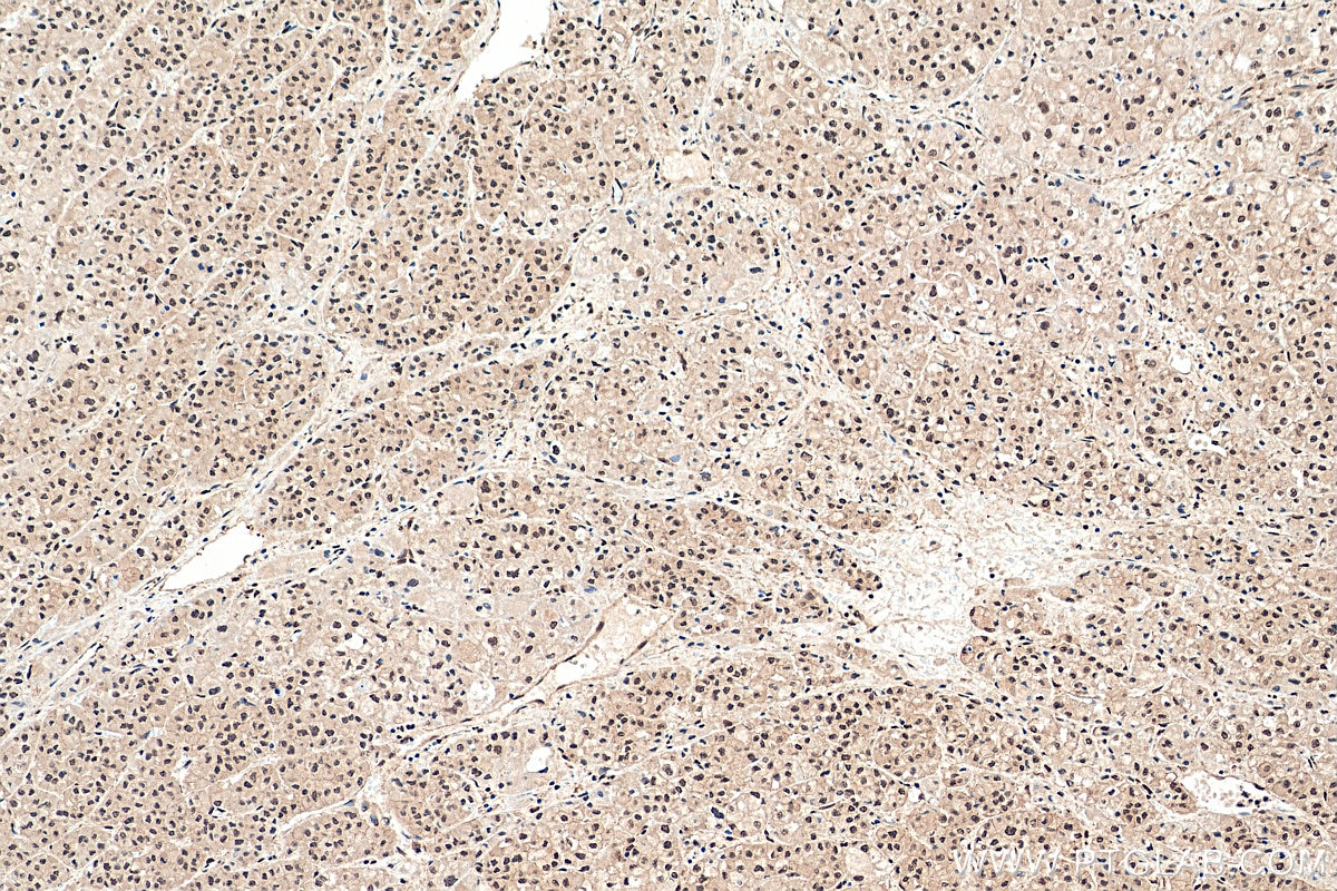 Immunohistochemistry (IHC) staining of human liver cancer tissue using PLK3 Polyclonal antibody (10977-1-AP)