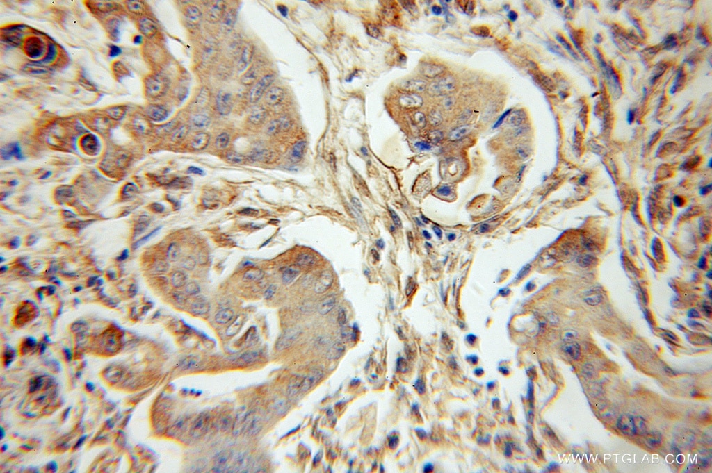 Immunohistochemistry (IHC) staining of human colon cancer tissue using PLK3 Polyclonal antibody (10977-1-AP)