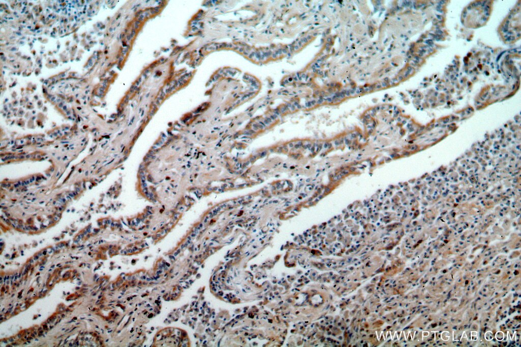 IHC staining of human lung cancer using 12952-1-AP