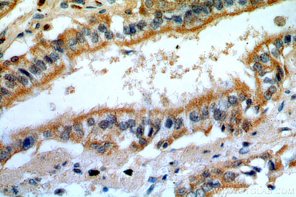Immunohistochemistry (IHC) staining of human lung cancer tissue using PLK4 Polyclonal antibody (12952-1-AP)