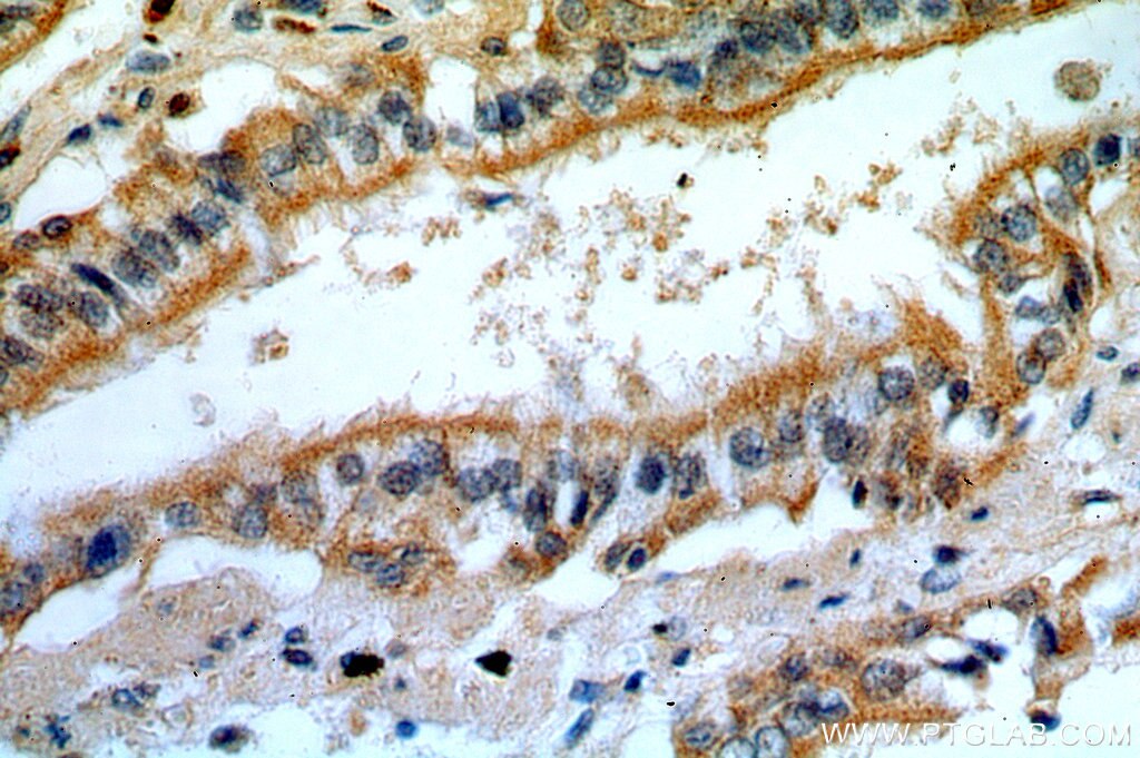 IHC staining of human lung cancer using 12952-1-AP