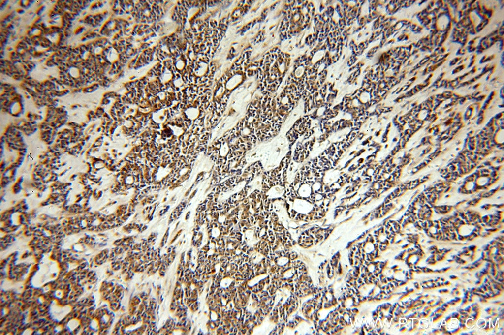 Immunohistochemistry (IHC) staining of human cervical cancer tissue using PLK4 Polyclonal antibody (12952-1-AP)
