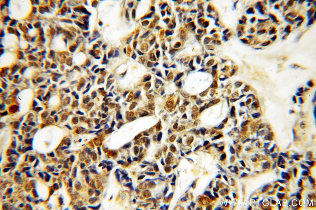 Immunohistochemistry (IHC) staining of human cervical cancer tissue using PLK4 Polyclonal antibody (12952-1-AP)