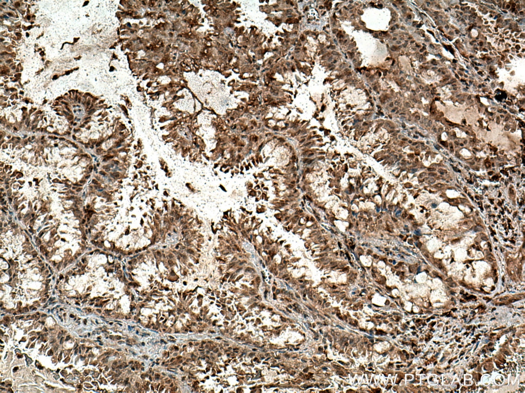 IHC staining of human lung cancer using 28750-1-AP