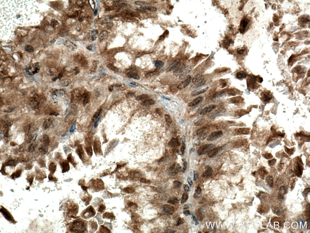 IHC staining of human lung cancer using 28750-1-AP
