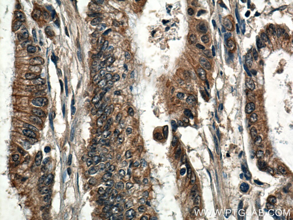 IHC staining of human colon cancer using 28750-1-AP