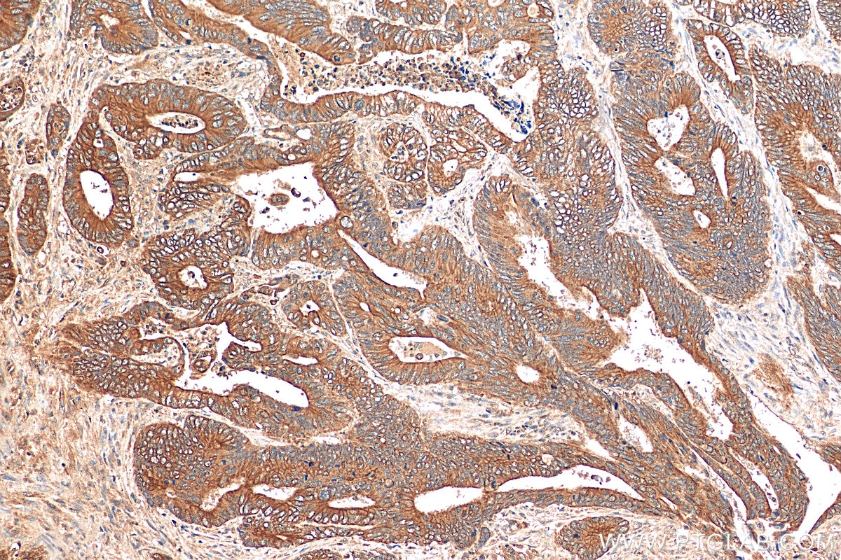 Immunohistochemistry (IHC) staining of human colon cancer tissue using PLK4 Polyclonal antibody (28750-1-AP)