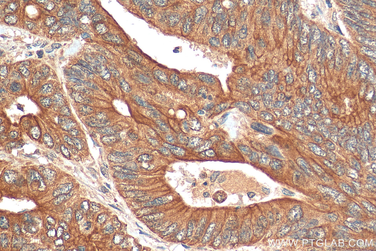 Immunohistochemistry (IHC) staining of human colon cancer tissue using PLK4 Polyclonal antibody (28750-1-AP)