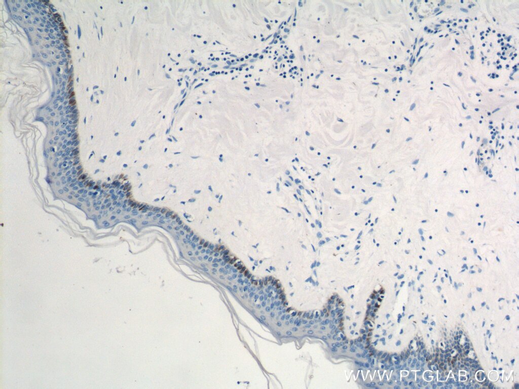 IHC staining of human skin cancer using 12475-1-AP