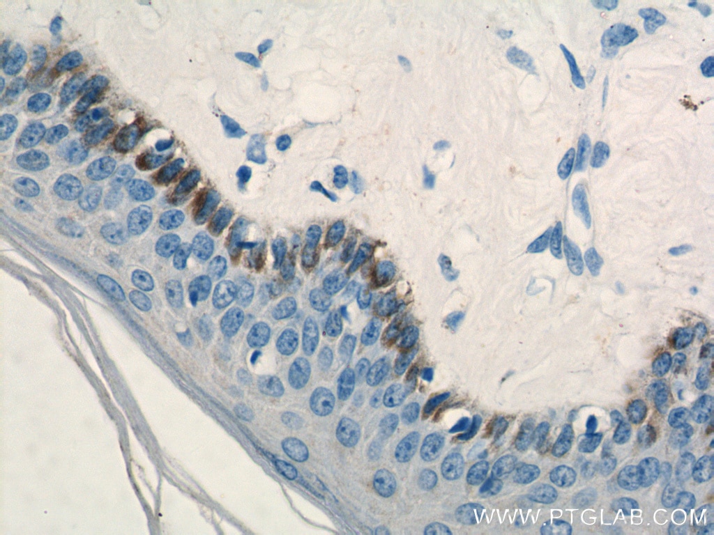 Immunohistochemistry (IHC) staining of human skin cancer tissue using PLOD1 Polyclonal antibody (12475-1-AP)