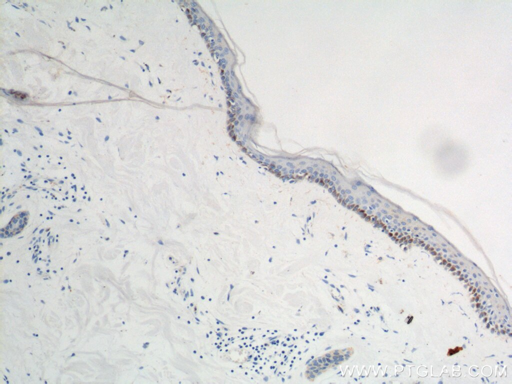 Immunohistochemistry (IHC) staining of human skin cancer tissue using PLOD1 Polyclonal antibody (12475-1-AP)