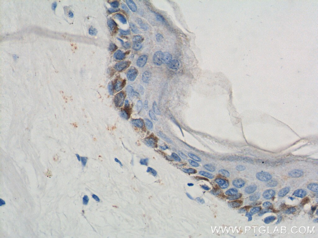 Immunohistochemistry (IHC) staining of human skin cancer tissue using PLOD1 Polyclonal antibody (12475-1-AP)