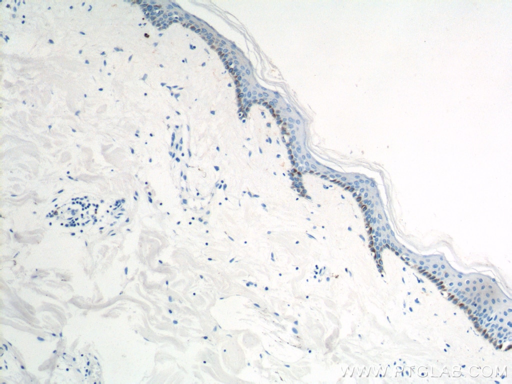 IHC staining of human skin cancer using 12475-1-AP