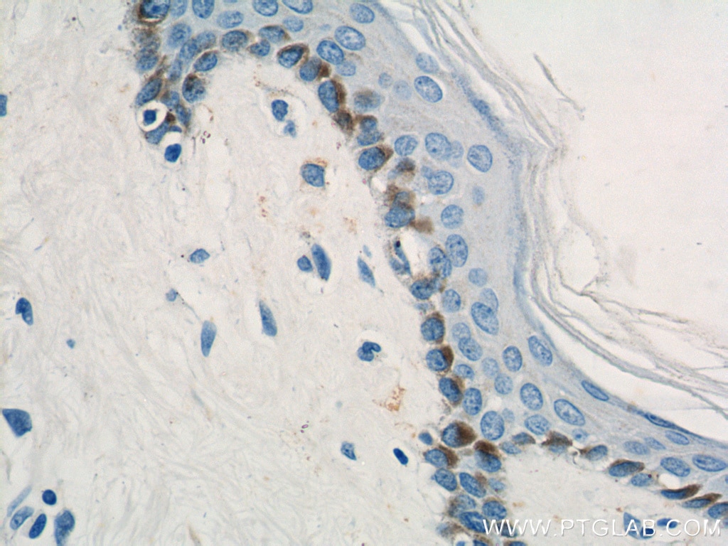 Immunohistochemistry (IHC) staining of human skin cancer tissue using PLOD1 Polyclonal antibody (12475-1-AP)