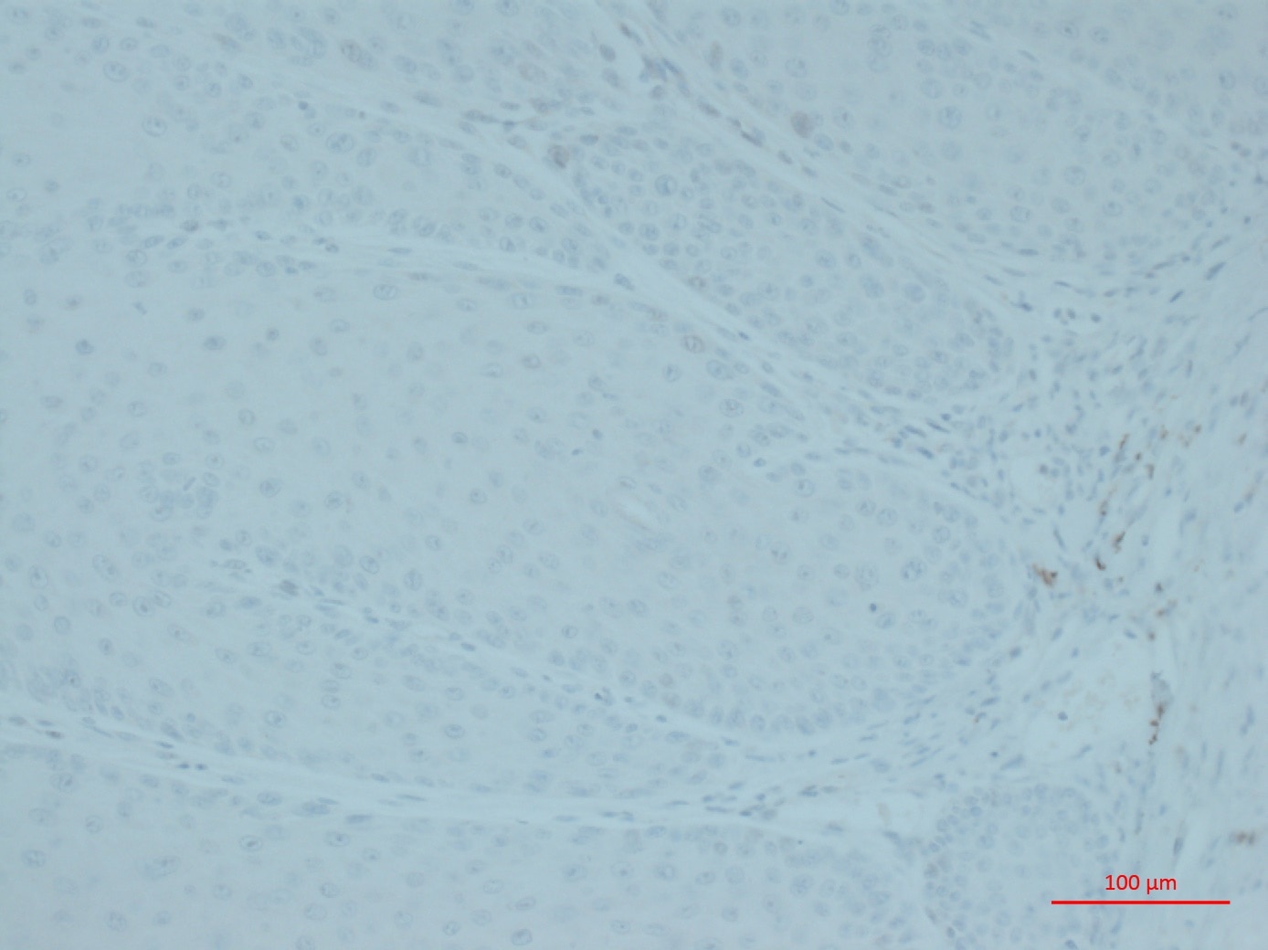 Immunohistochemistry (IHC) staining of Mouse skin papilloma using PLOD1 Polyclonal antibody (12475-1-AP)