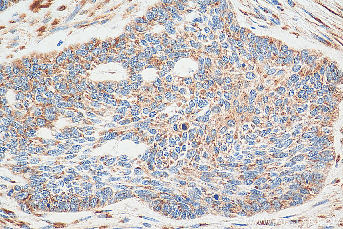 Immunohistochemistry (IHC) staining of human skin cancer tissue using PLOD1 Polyclonal antibody (29480-1-AP)