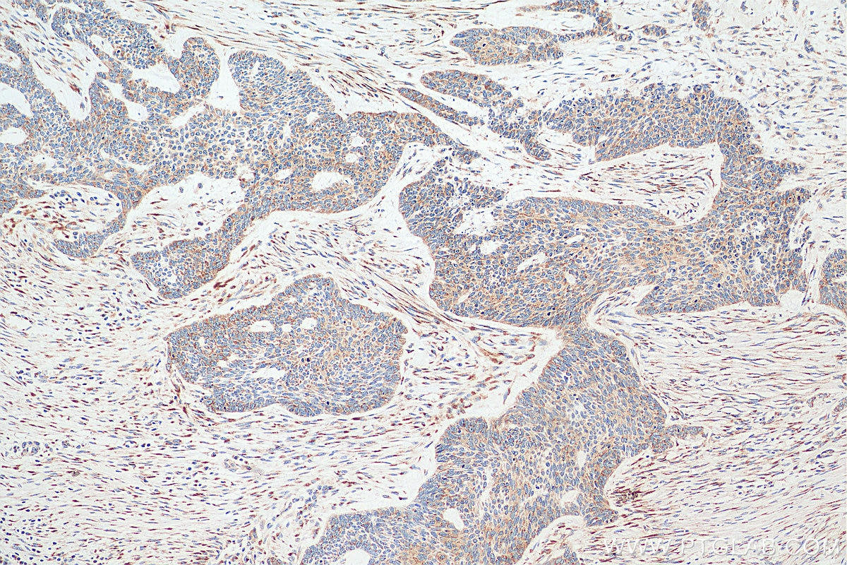 Immunohistochemistry (IHC) staining of human skin cancer tissue using PLOD1 Polyclonal antibody (29480-1-AP)