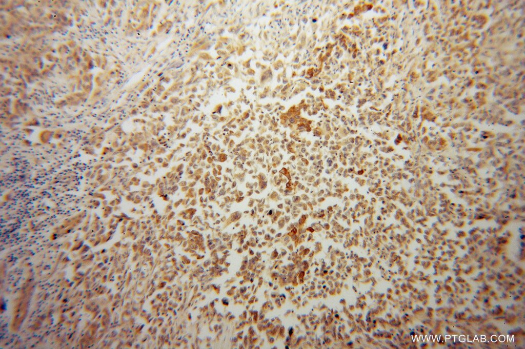 Immunohistochemistry (IHC) staining of human pancreas cancer tissue using PLOD2 Polyclonal antibody (13453-1-AP)