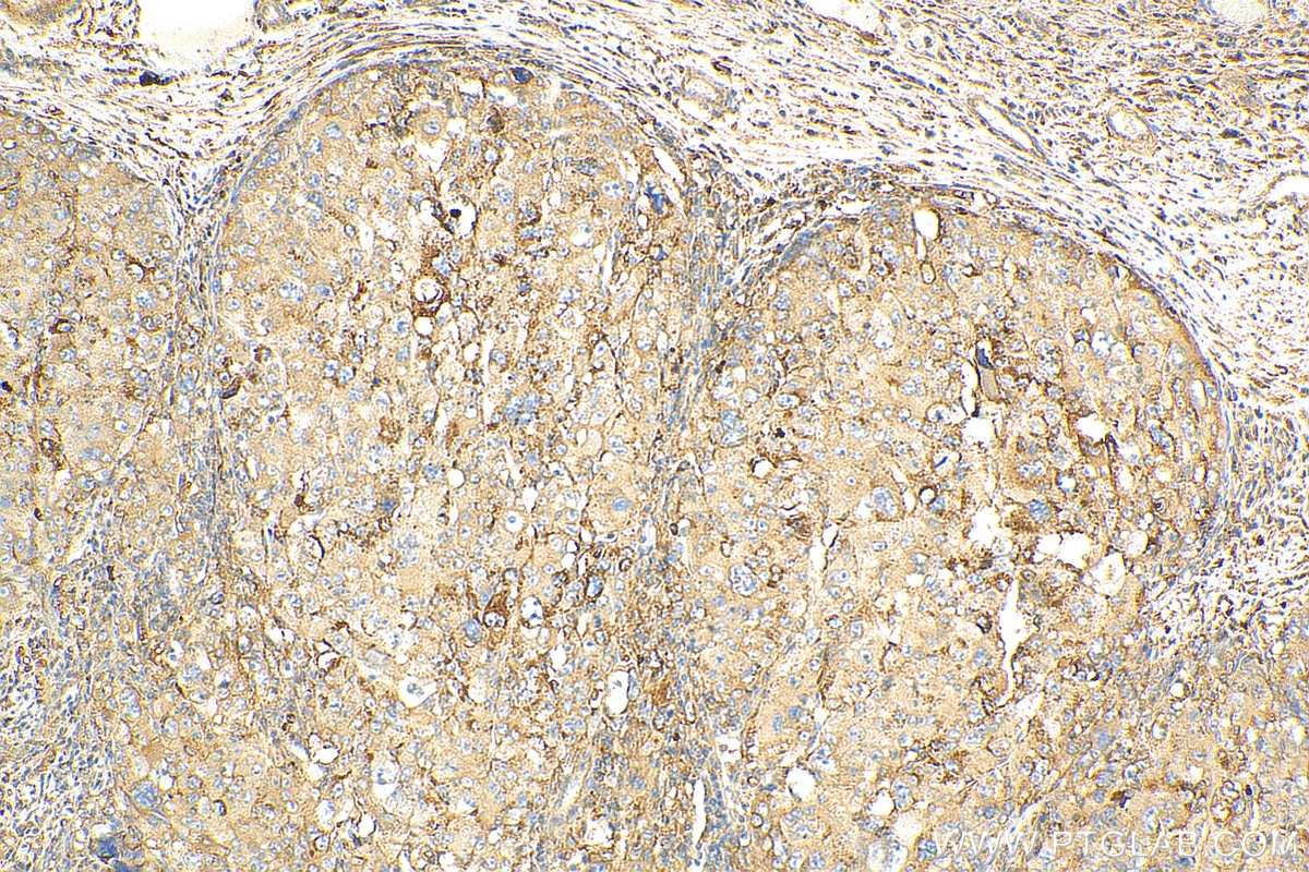 IHC staining of human liver cancer using 21214-1-AP