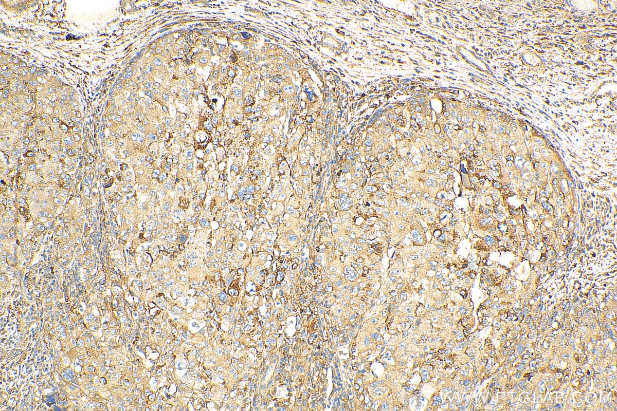 Immunohistochemistry (IHC) staining of human liver cancer tissue using PLOD2-Specific Polyclonal antibody (21214-1-AP)