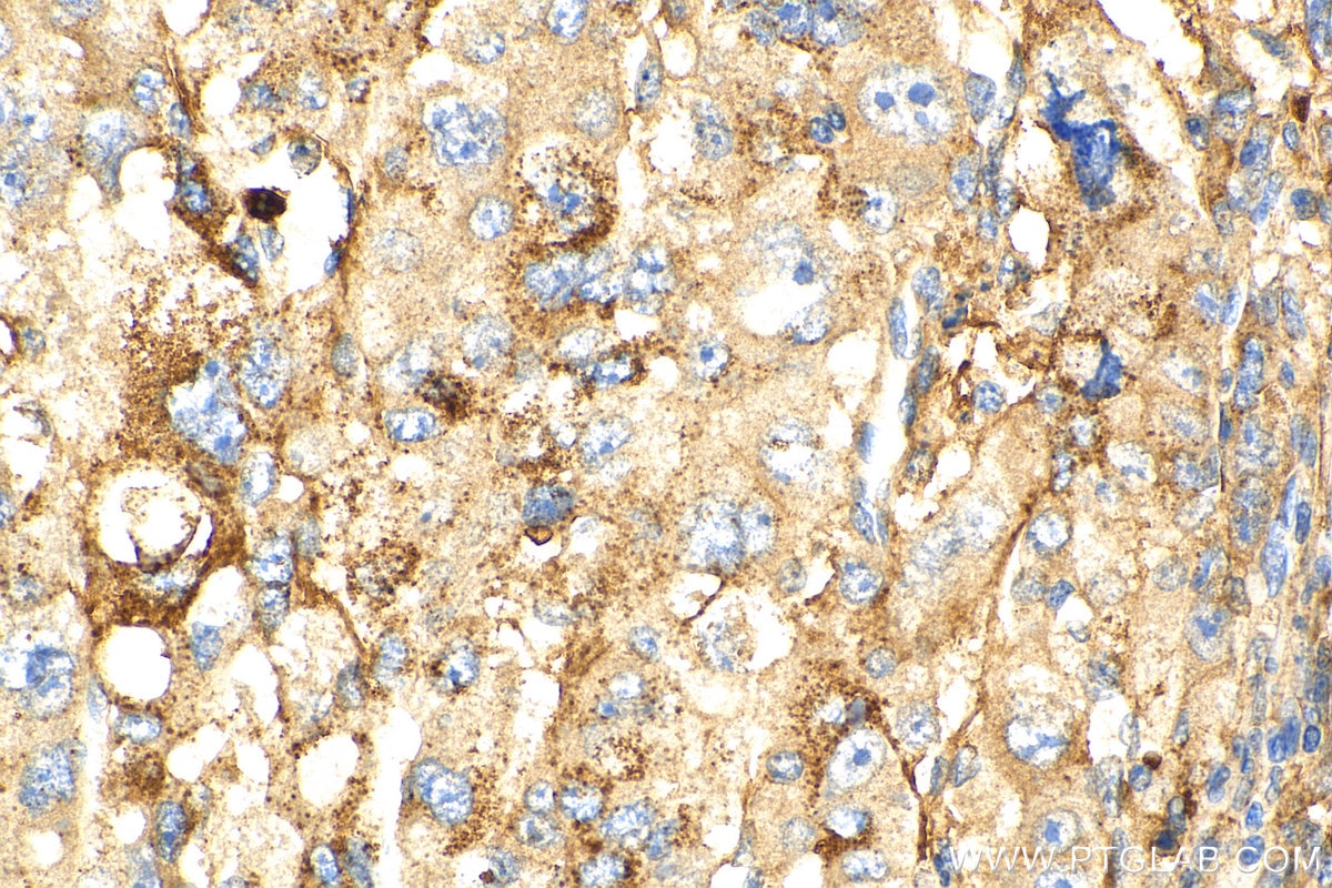 Immunohistochemistry (IHC) staining of human liver cancer tissue using PLOD2-Specific Polyclonal antibody (21214-1-AP)